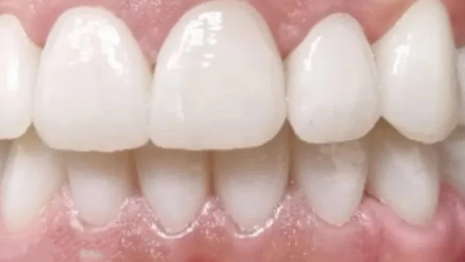 Después: Rehabilitación Oral