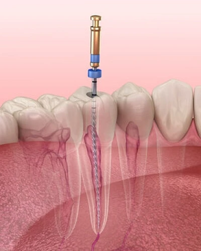 Reendodoncias