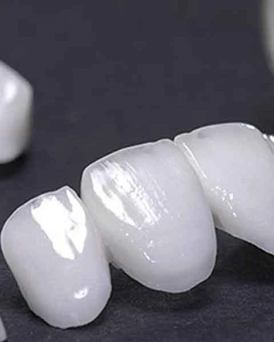 Carillas de Porcelana