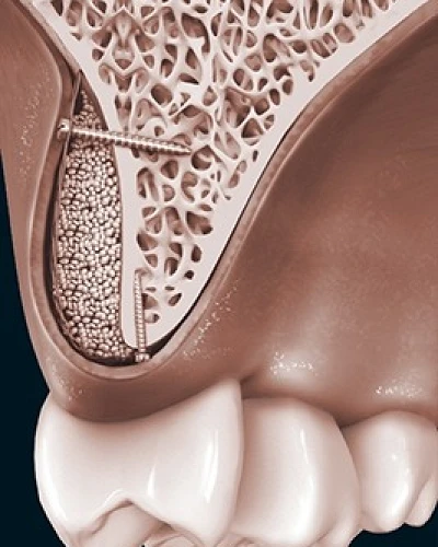 Regeneración Ósea y Tisular