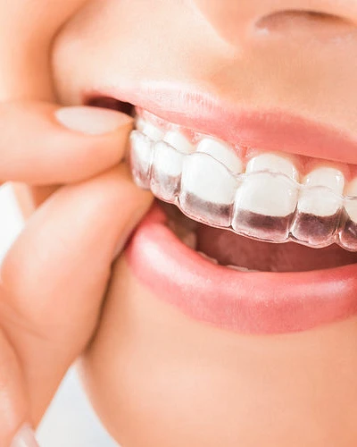 Ortodoncia Invisible (Invisalign)